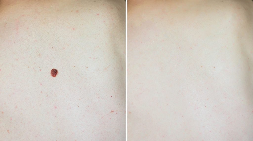 Skin Tags Removal
