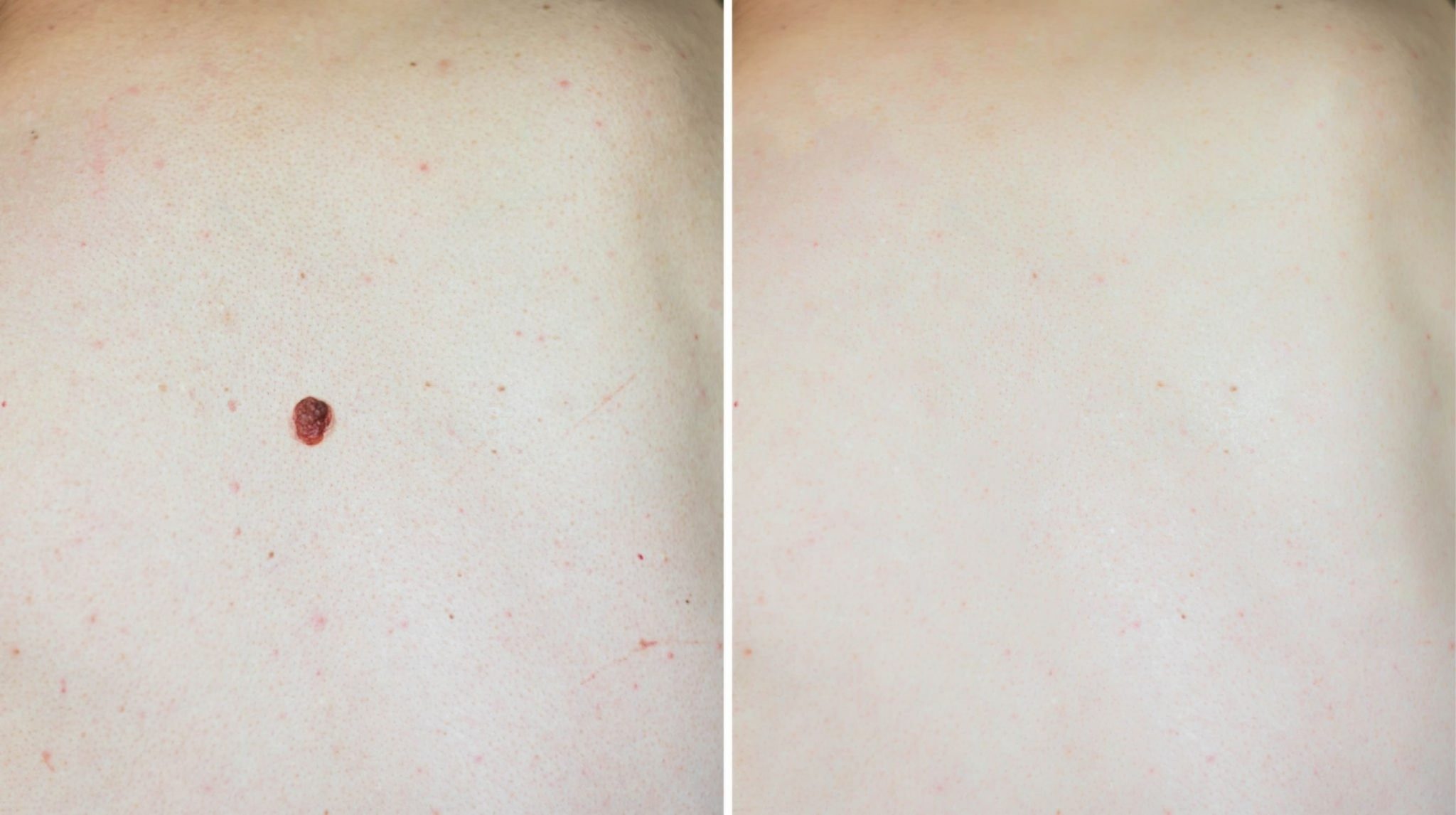 Skin Tags Removal Treatment in Kothrud Pune Taj Skin Clinic