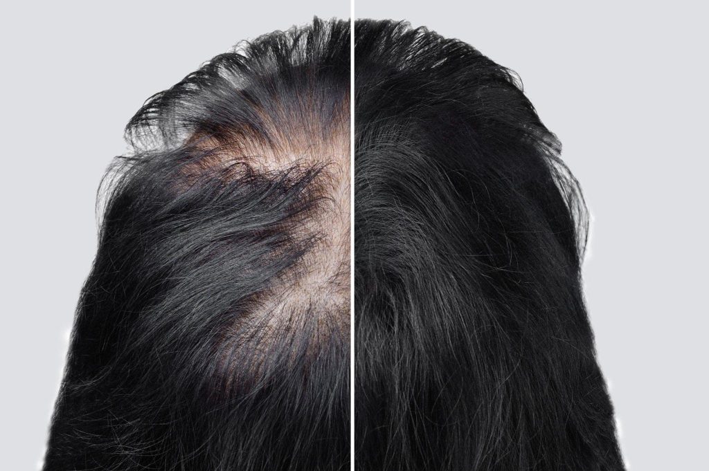 Hair Fall / Hair Loss & Hair Thinning Treatments