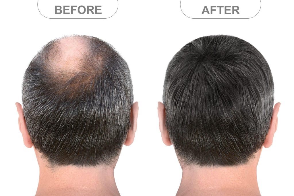 Hair Loss In Men