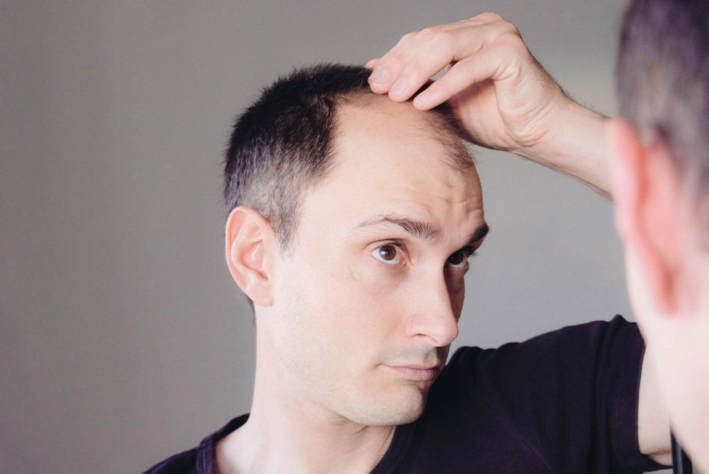 Hair Loss In Men