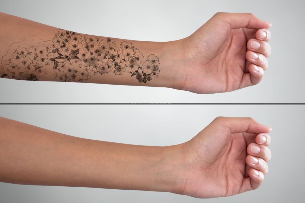 Permanent Tattoo Removal Treatment